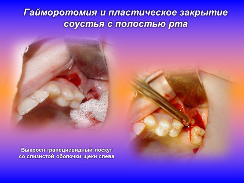Гайморотомия и пластическое закрытие соустья с полостью рта Выкроен трапециевидный лоскут со слизистой оболочки